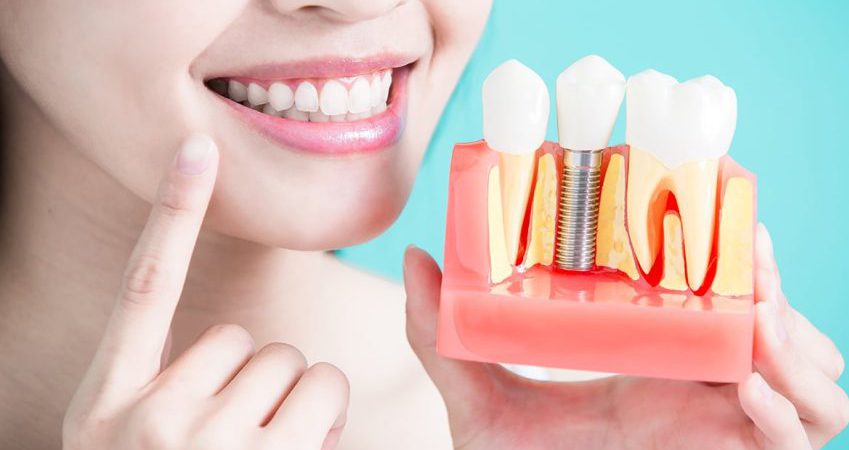 افزایش کیفیت زندگی با ایمپلنت دندان | مرکز ایمپلنت اصفهان