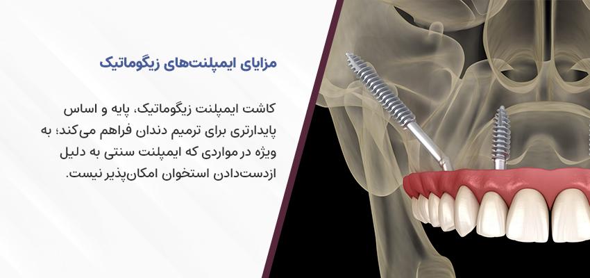 مزایای ایمپلنت زیگوماتیک | مرکز ایمپلنت دکتر فرهاد اسماعیلی در اصفهان