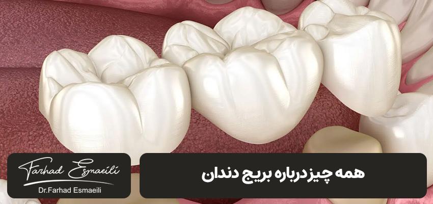 بریج دندان چیست؟ | مرکز ایمپلنت دکتر فرهاد اسماعیلی در اصفهان