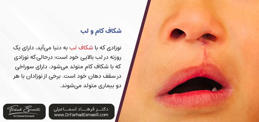 شکاف کام و لب | دکتر فرهاد اسماعیلی در اصفهان