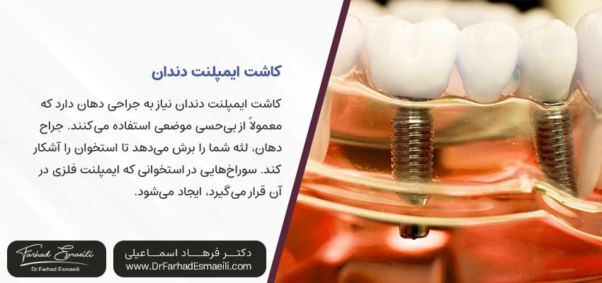 کاشت ایمپلنت دندان | بهترین متخصص ایمپلنت اصفهان