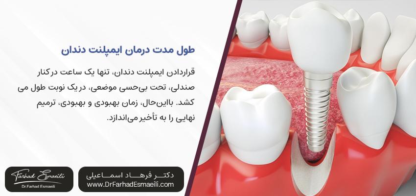 مدت زمان درمان دندانپزشکی ایمپلنت | ایمپلنت تک دندان در اصفهان