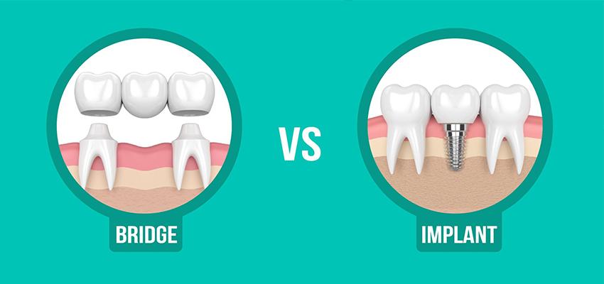 مزایای ایمپلنت دندان نسبت به بریج | ایمپلنت یک دندان