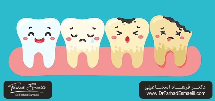 پوسیدگی دندان | دکتر فرهاد اسماعیلی