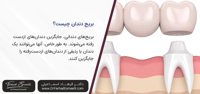 بریج دندان | ایمپلنت دکتر فرهاد اسماعیلی