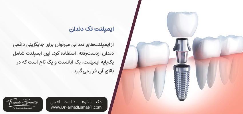 ایمپلنت تک دندانی چیست؟ | مرکز تخصصی ایمپلنت اصفهان