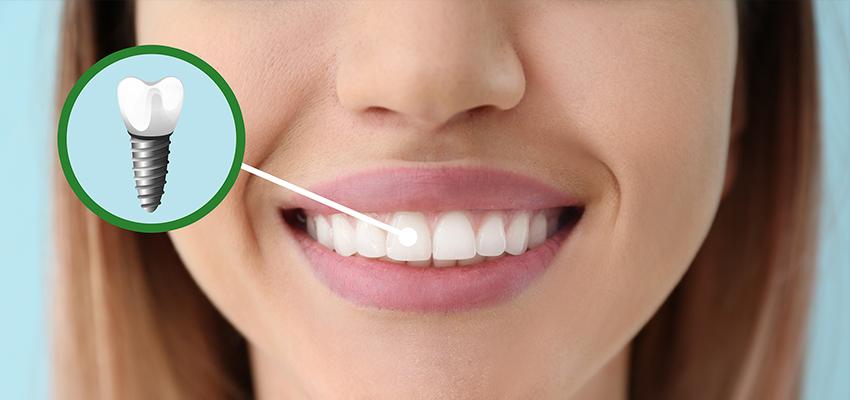 ایمپلنت دندان | مطب ایمپلنت دیجیتال اصفهان