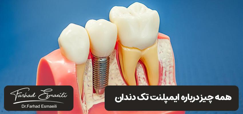 ایمپلنت تک دندانی | دکتر فرهاد اسماعیلی در اصفهان