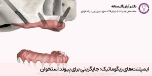 ایمپلنت زیگوماتیک | مطب دکتر فرهاد اسماعیلی در اصفهان