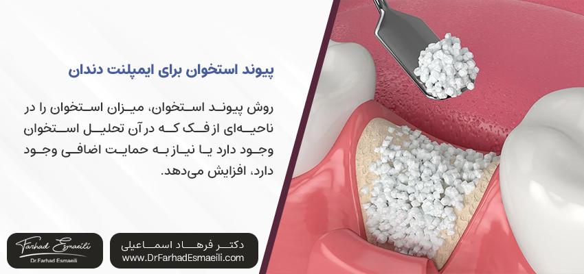 پیوند استخوان برای ایمپلنت دندان | کلینیک ایمپلنت اصفهان