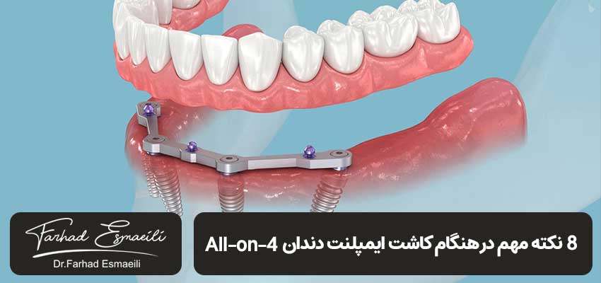 8 نکته مهم در هنگام کاشت ایمپلنت دندان All-on-4 | دکتر فرهاد اسماعیلی