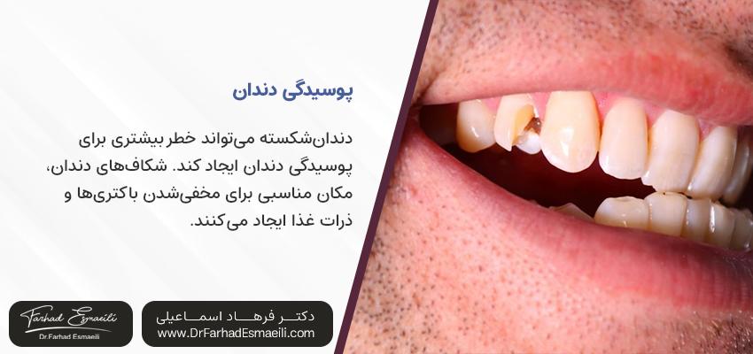 عواقب شکستگی دندان | دندان شکسته