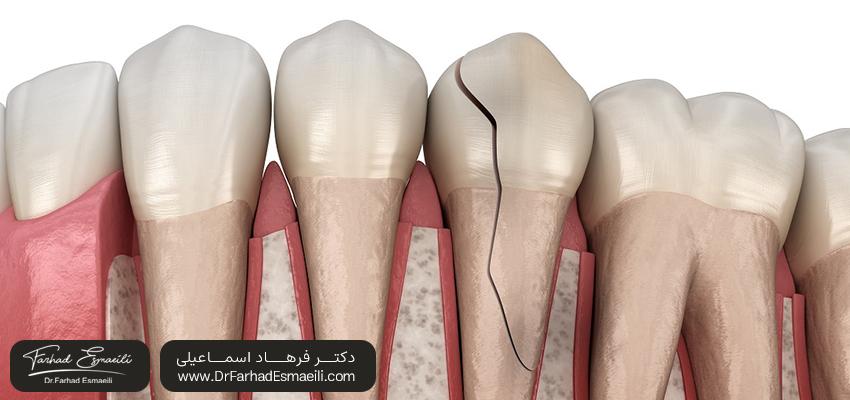 دندان ترک خورده | مرکز ایمپلنت دیجیتال دکتر فرهاد اسماعیلی