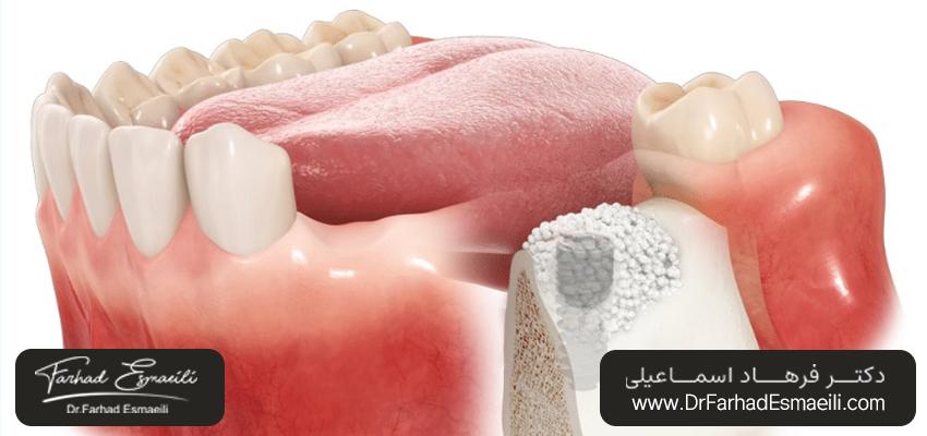 پیوند استخوان دندان | مرکز ایمپلنت دیجیتال اصفهان