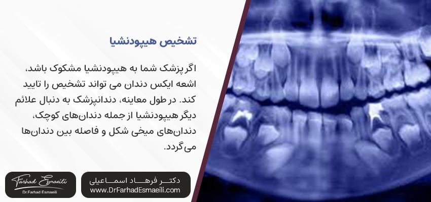 تشخیص هیپودنشیا | متخصص درمان هیپودنشیا