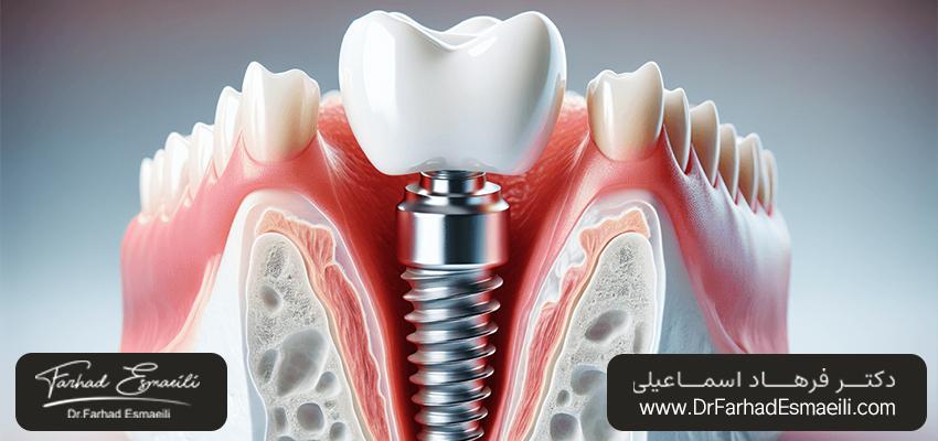 درمان هیپودنشیا با ایمپلنت دندان | مرکز ایمپلنت دندان اصفهان