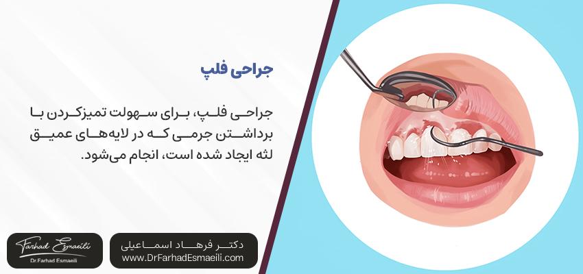 جراحی فلپ برای درمان دندان لق | دکتر فرهاد اسماعیلی