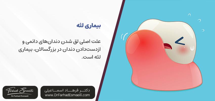 بیماری لثه و لق شدن دندان | مرکز دندان پزشکی دکتر فرهاد اسماعیلی 