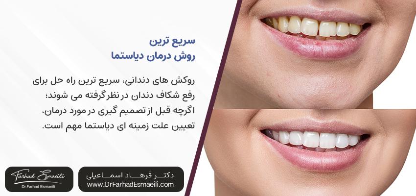 سریع ترین روش درمان فاصله بین دندانی | مطب دندانپزشکی دکتر فرهاد اسماعیلی در اصفهان