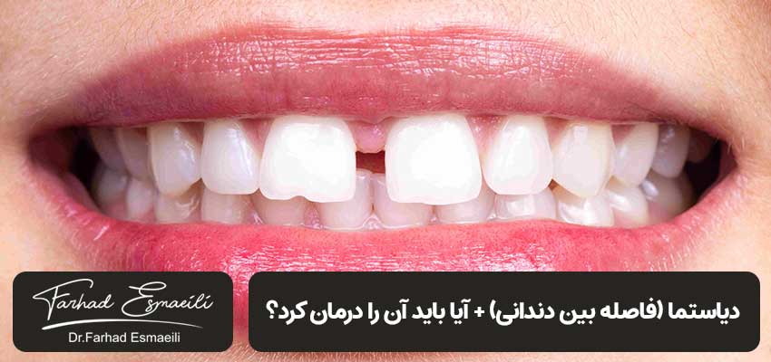 فاصله بین دندانی یا دیاستما | دکتر فرهاد اسماعیلی در اصفهان