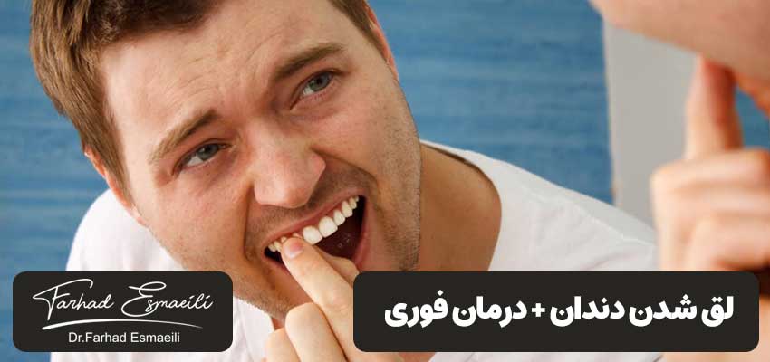 لق شدن دندان | مرکز دندانپزشکی دکتر فرهاد اسماعیلی
