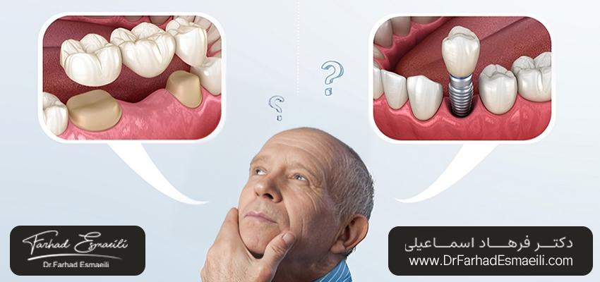 انتخاب پل دندان در مقابل ایمپلنت | بهترین مرکز ایمپلنت اصفهان