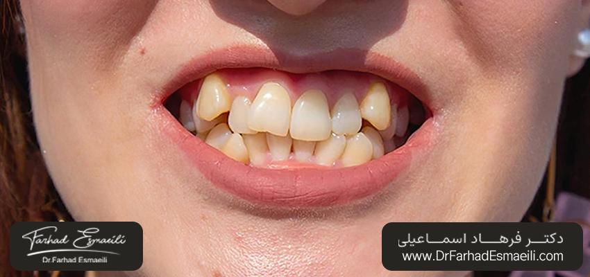 دندان کج | مرکز دندانپزشکی دیجیتال دکتر فرهاد اسماعیلی در اصفهان