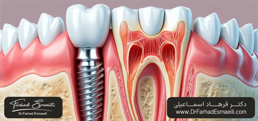 کاشت ایمپلنت دندان | مرکز ایمپلنت دیجیتال دکتر فرهاد اسماعیلی