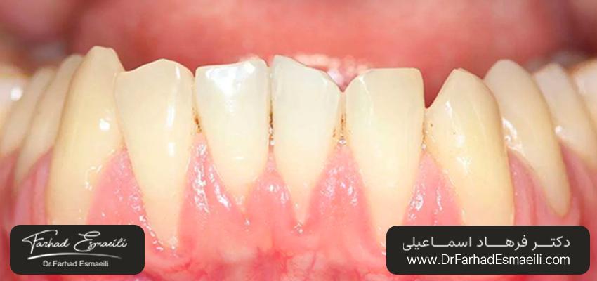 تحلیل لثه | مرکز ایمپلنت دیجیتال دکتر فرهاد اسماعیلی
