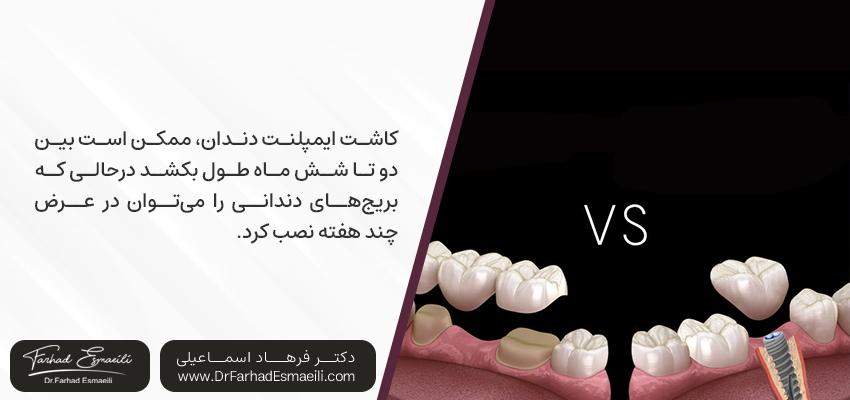 طول درمان ایمپلنت دندان در مقابل بریج | دکتر فرهاد اسماعیلی