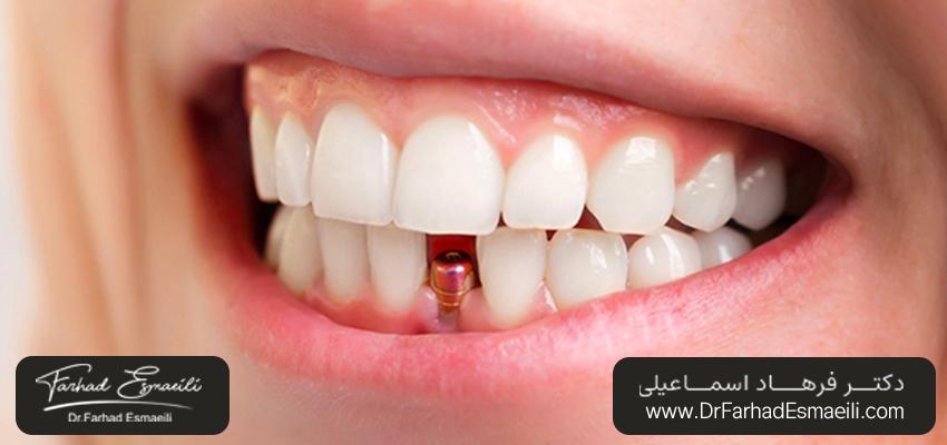 شل‌شدن و افتادن تاج دندان | دکتر فرهاد اسماعیلی