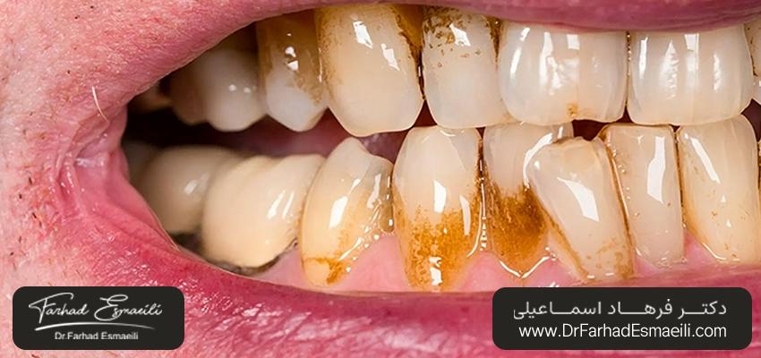 دندان های لکه دار | دکتر فرهاد اسماعیلی
