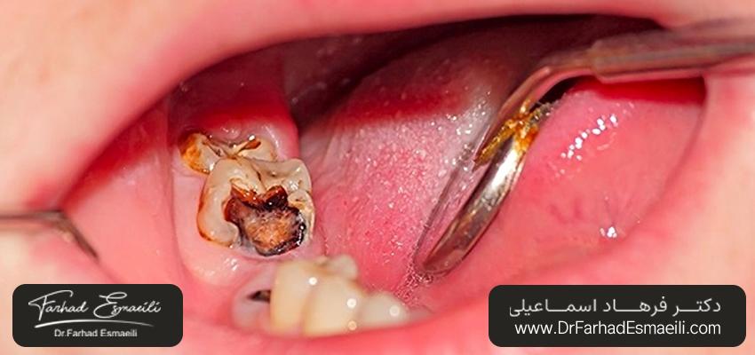پوسیدگی دندان | مطب دندانپزشکی دکتر فرهاد اسماعیلی