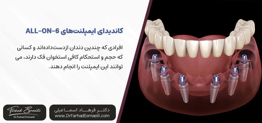 چه کسانی می توانند ایمپلنت های دندانی All-on-6 را دریافت کنند؟ | دکتر فرهاد اسماعیلی