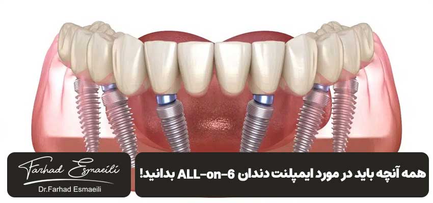 همه آنچه باید در مورد ایمپلنت دندان ALL-on-6 بدانید! | دکتر فرهاد اسماعیلی
