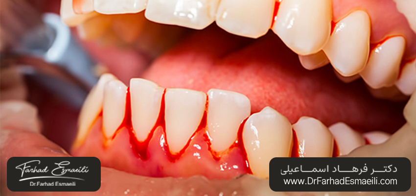 خونریزی لثه | دکتر فرهاد اسماعیلی در اصفهان