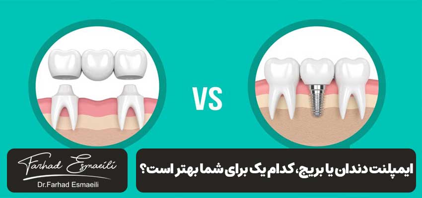 ایمپلنت دندان یا بریج، کدام یک برای شما بهتر است؟ | دکتر فرهاد اسماعیلی