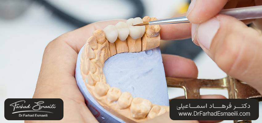 بریج دندان | دکتر فرهاد اسماعیلی