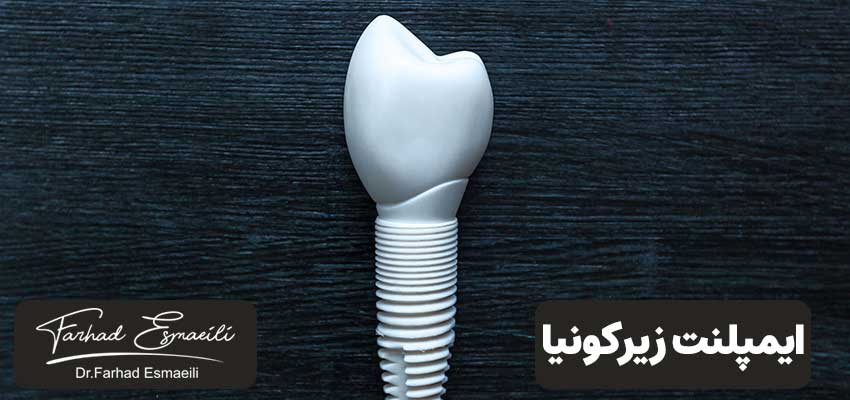 نکاتی که باید درباره ایمپلنت زیرکونیا بدانید! | دکتر فرهاد اسماعیلی
