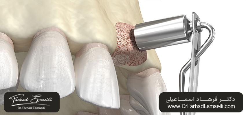 پیوند استخوان برای جایگزینی ایمپلنت | مطب دکتر فرهاد اسماعیلی در اصفهان