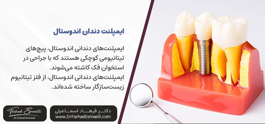 ایمپلنت دندان اندوستال | دکتر فرهاد اسماعیلی در اصفهان