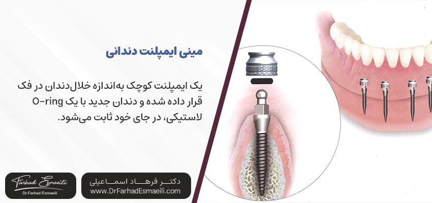 مینی ایمپلنتهای دندانی چیست؟ | دکتر فرهاد اسماعیلی