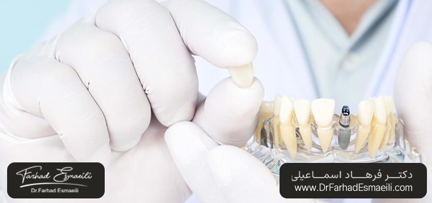 رایج‌ترین نوع ایمپلنت اندوستال، کدام است؟ | دکتر فرهاد اسماعیلی