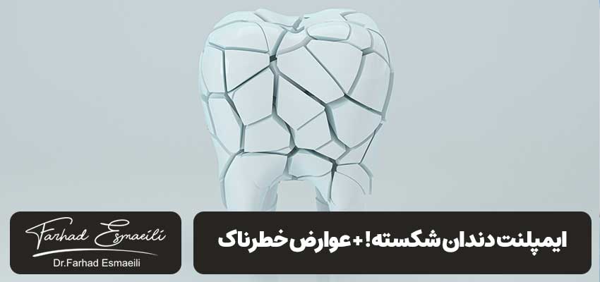 ایمپلنت دندان شکسته! + عوارض خطرناک + راه حل پیشنهادی | دکتر فرهاد اساعیلی