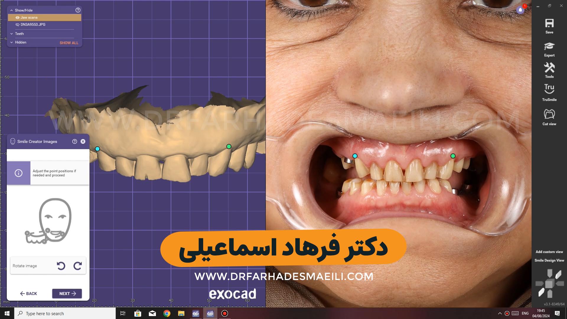 کاشت ایمپلنت دیجیتال با استفاده از ایمپلنت برند sic بیمار عزیز از شیراز