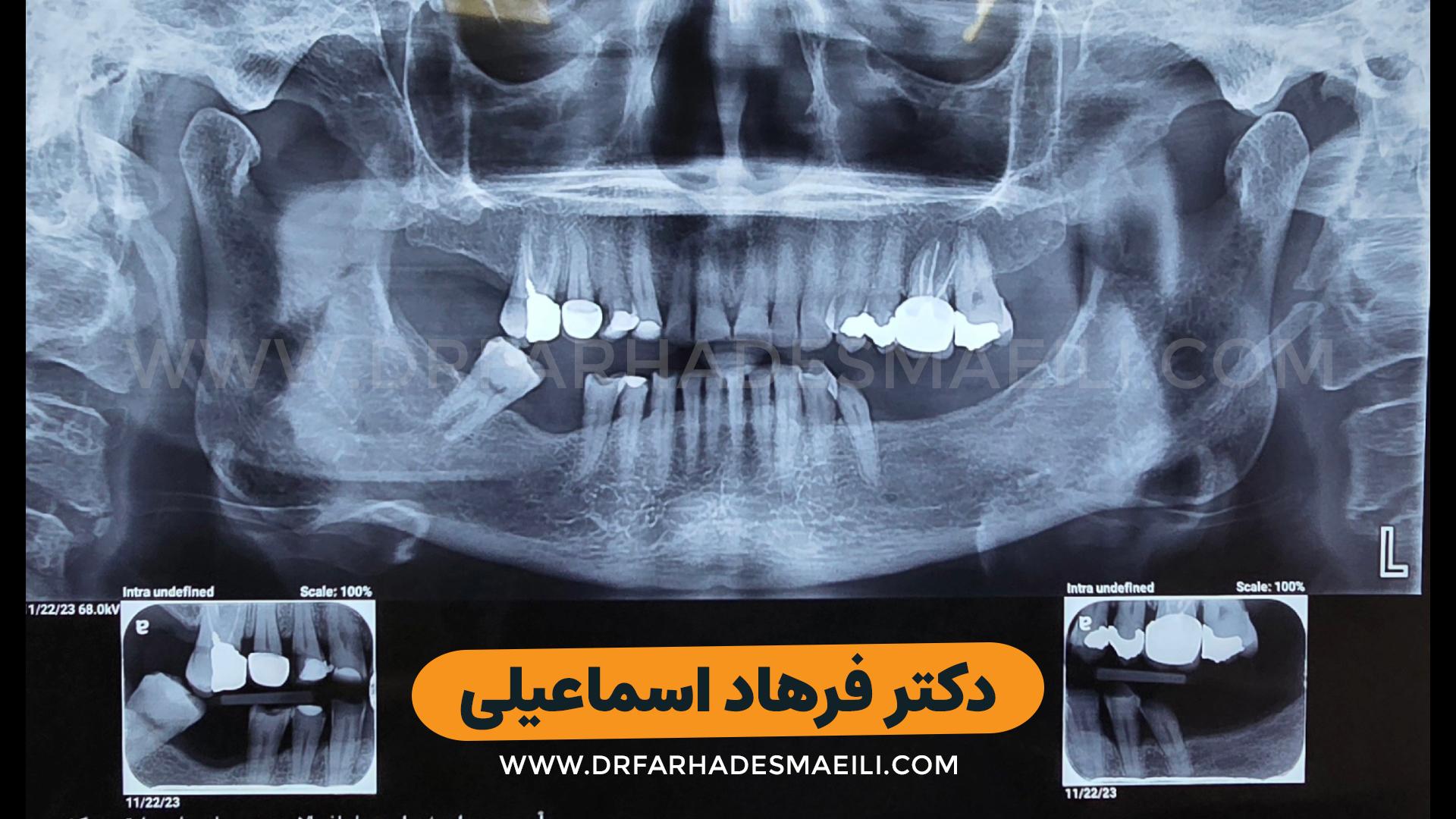 کاشت ایمپلنت دیجیتال با استفاده از ایمپلنت برند sic بیمار عزیز از شیراز