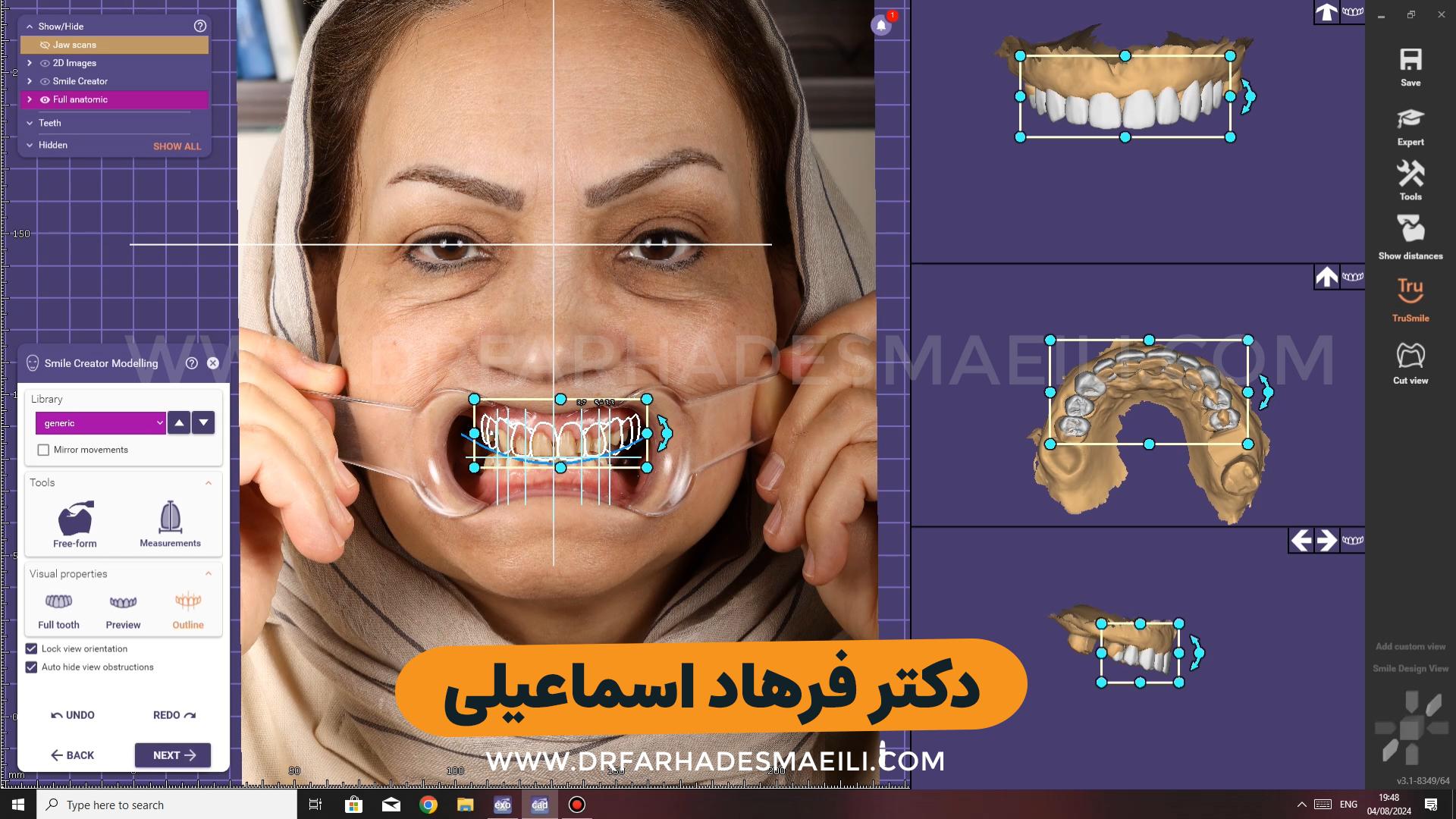 طراحی و اصلاح طرح لبخند بیمار عزیز از شیراز با استفاده از ایمپلنت دیجیتال و روکش سرامیکی
