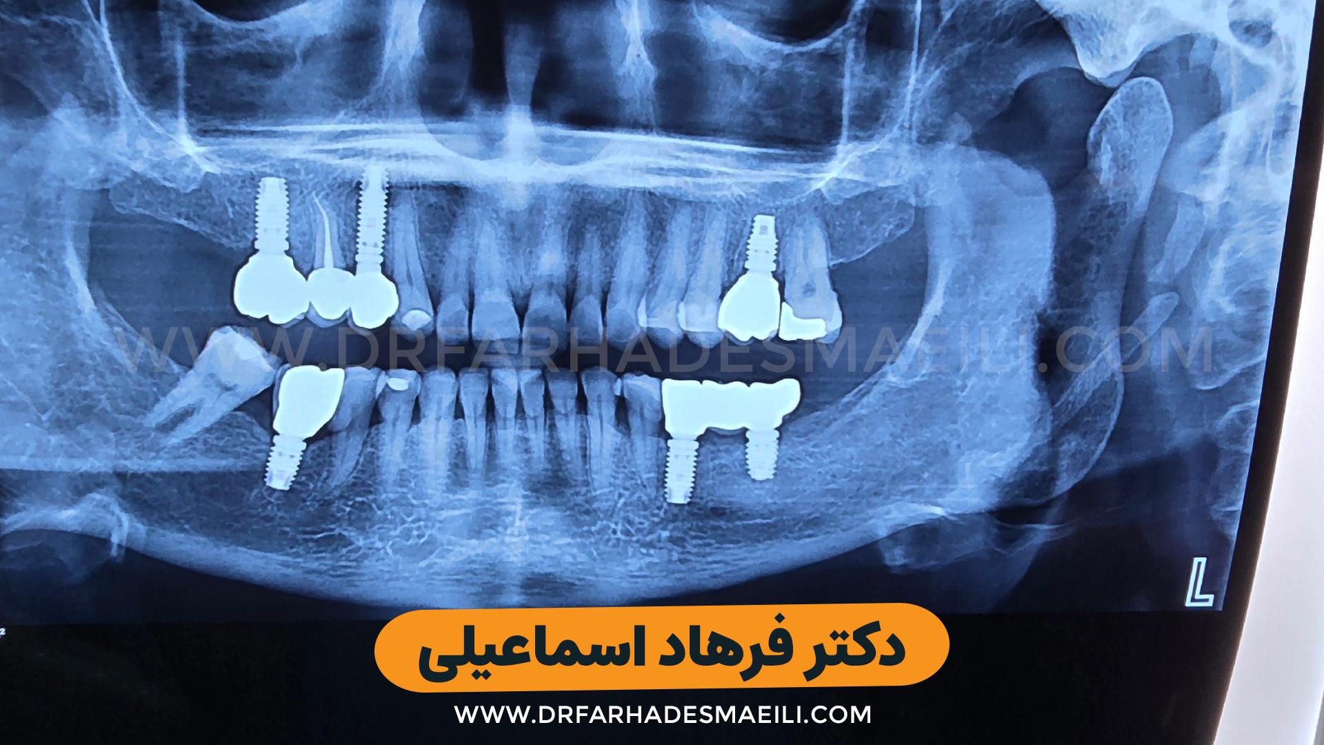کاشت ایمپلنت دیجیتال با استفاده از ایمپلنت برند sic بیمار عزیز از شیراز