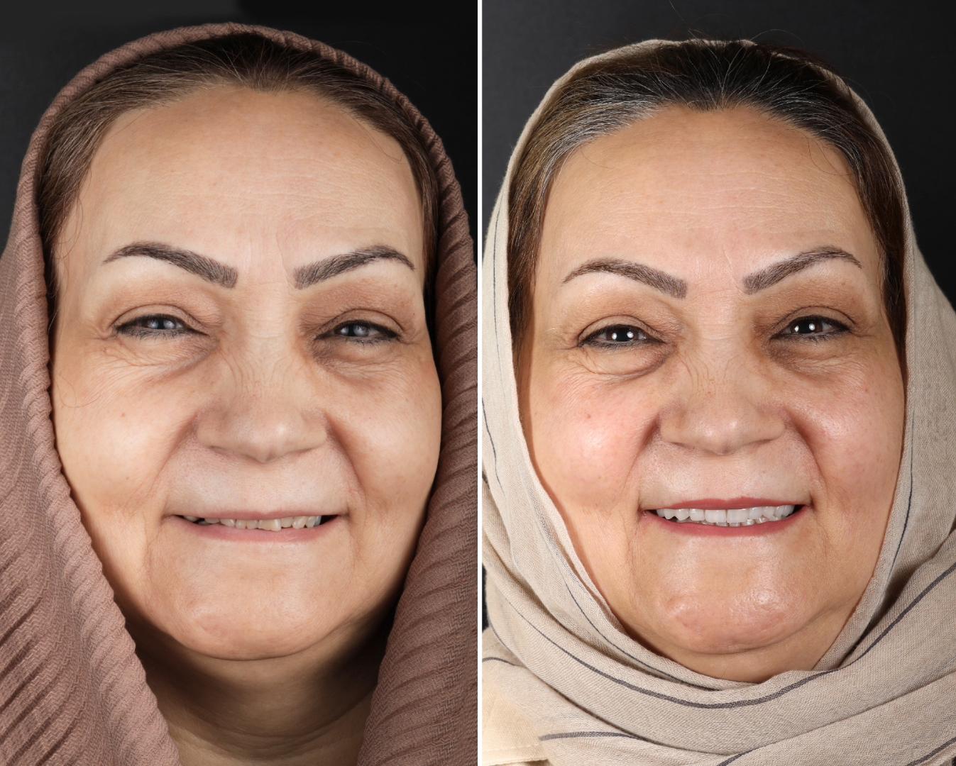 طراحی و اصلاح طرح لبخند بیمار عزیز از شیراز با استفاده از ایمپلنت دیجیتال و روکش سرامیکی