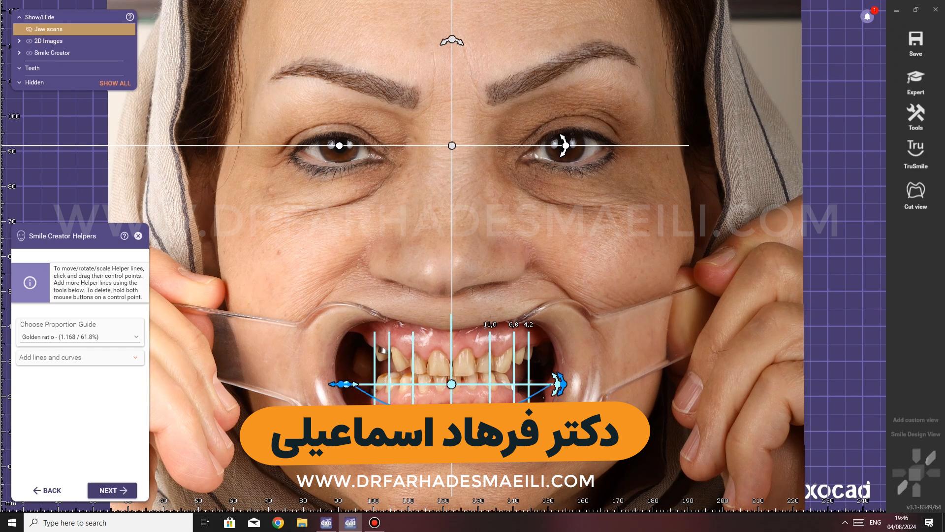 طراحی و اصلاح طرح لبخند بیمار عزیز از شیراز با استفاده از ایمپلنت دیجیتال و روکش سرامیکی